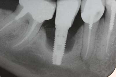 Impianto dentale rigetto sintomi
