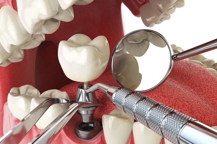 Impianto dentale intervento - Dentista Croazia 4Smile
