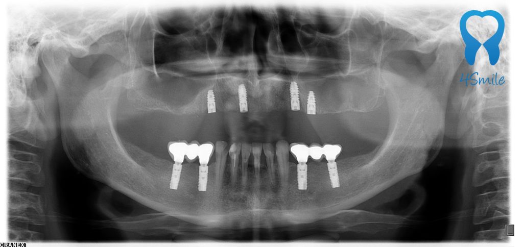 Impianti dentali esperienze - Dentista Croazia 4Smile