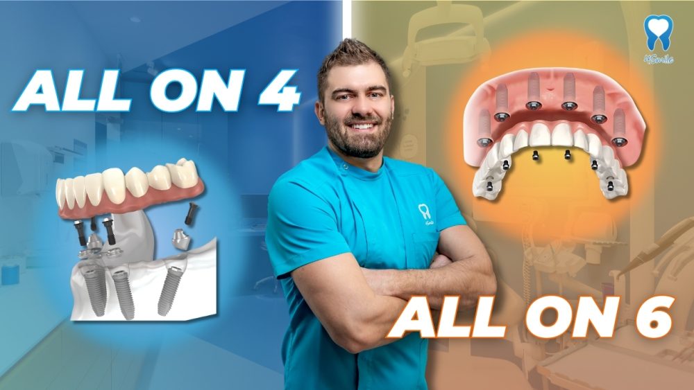 la-differenza-tra-impianti-dentali-all-on-4-e-all-on-6-qual-e-lopzione-migliore la-differenza-tra-impianti-dentali-all-on-4-e-all-on-6-qual-e-lopzione-migliore